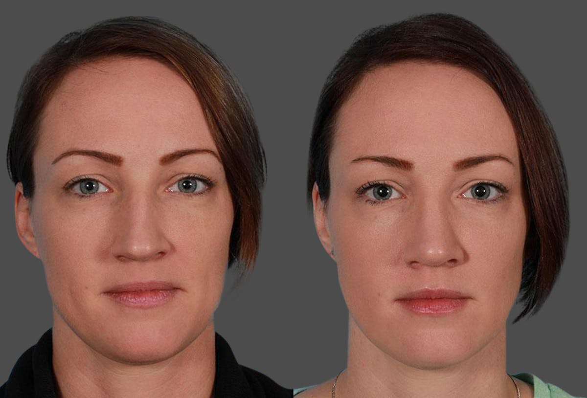 Nasal Obstruction Before & After Gallery - Patient 132748 - Image 1