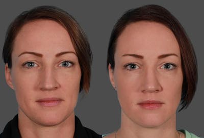 Rhinoplasty Before & After Gallery - Patient 795474 - Image 1