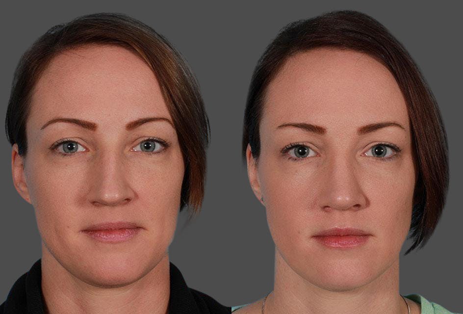 Nasal Obstruction Before & After Gallery - Patient 132748 - Image 1