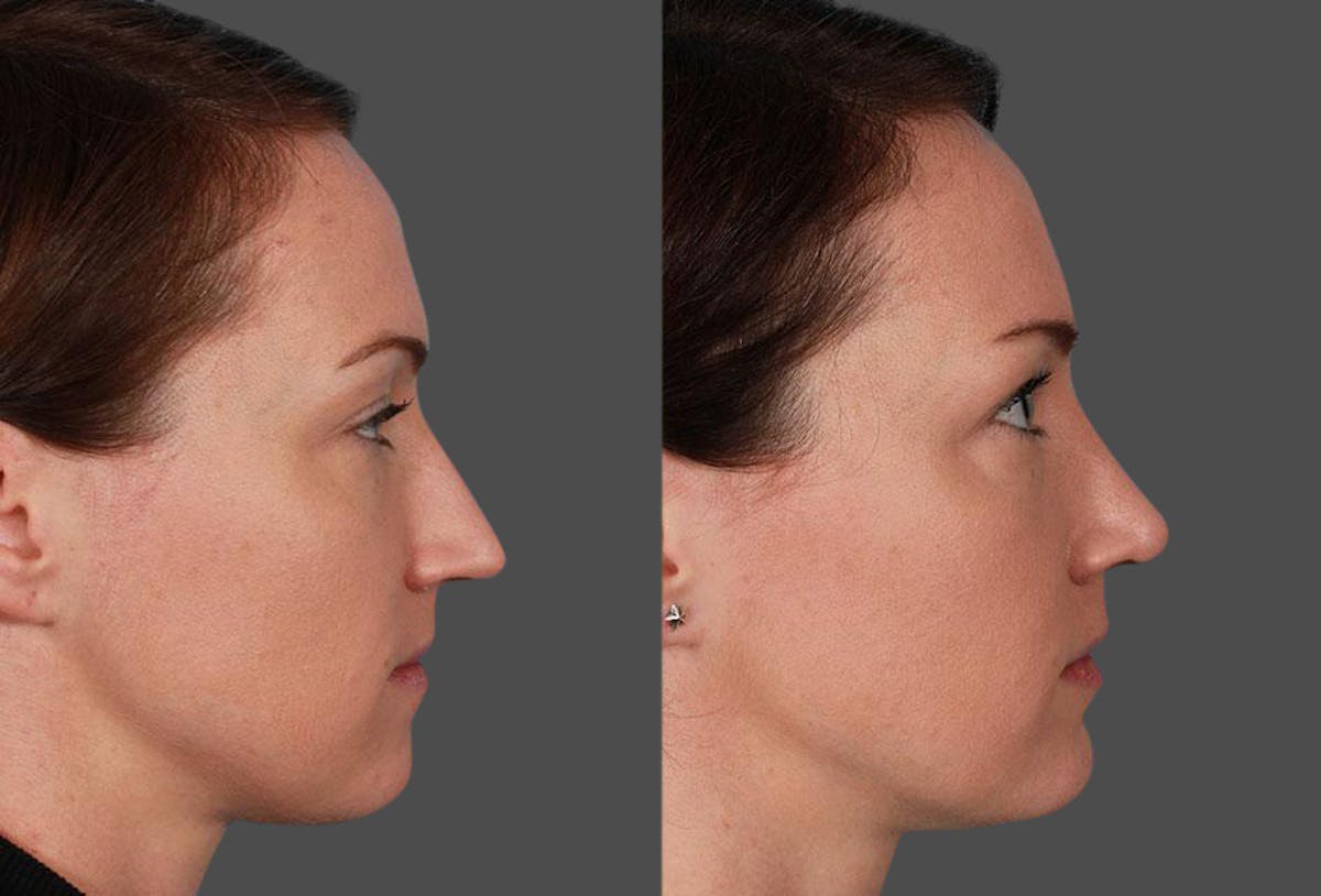 Nasal Obstruction Before & After Gallery - Patient 132748 - Image 2
