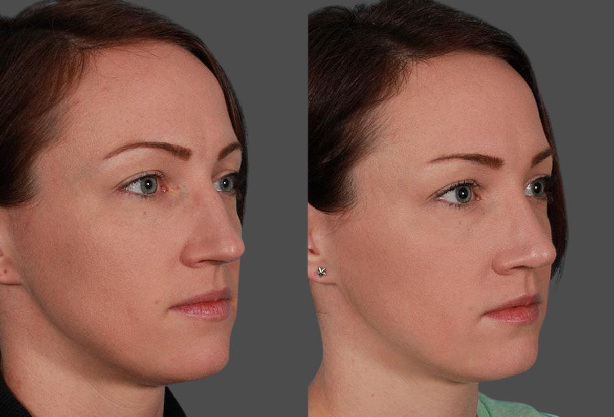 Nasal Obstruction Before & After Gallery - Patient 132748 - Image 3