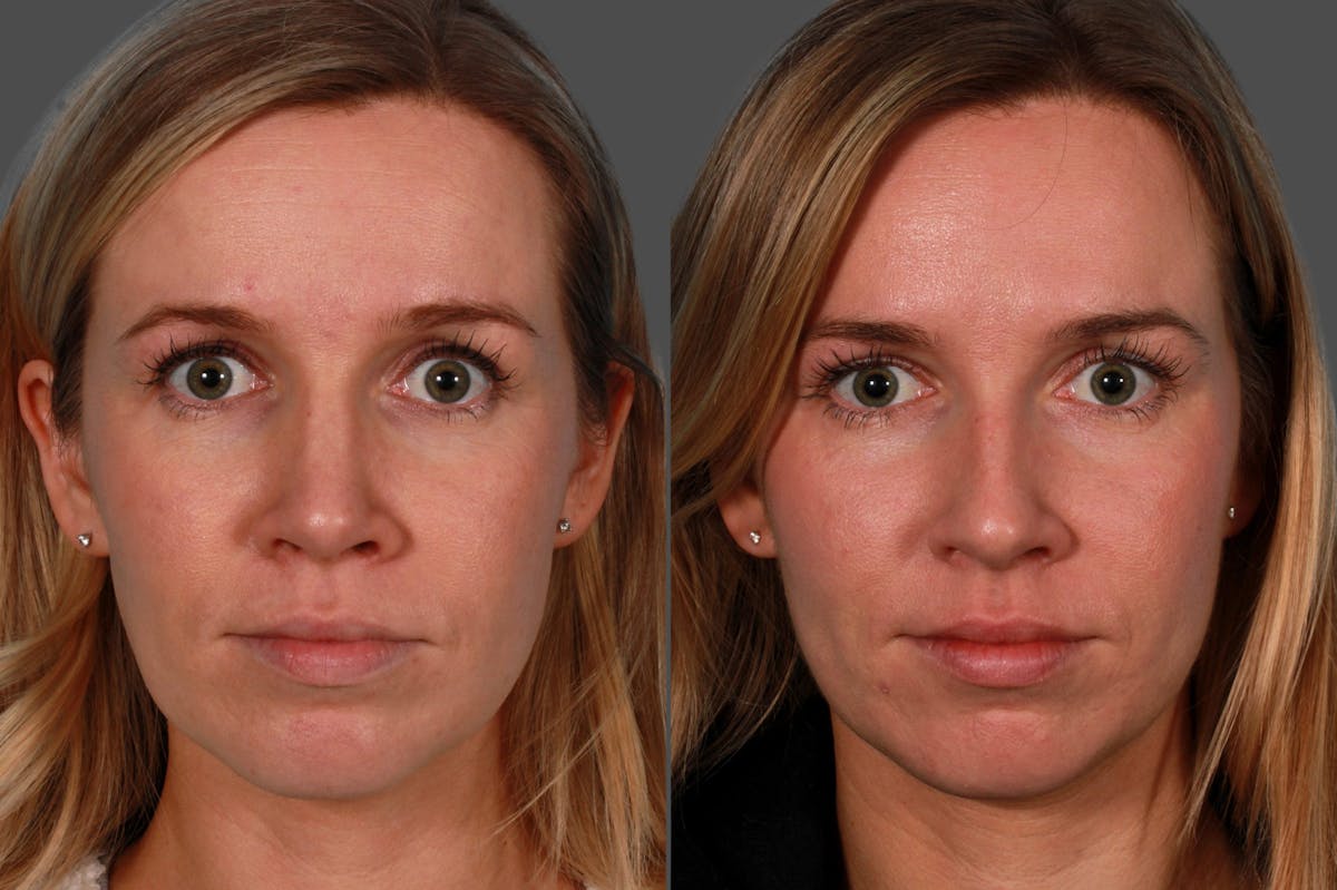 Rhinoplasty Before & After Gallery - Patient 937377 - Image 1
