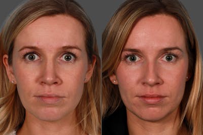 Rhinoplasty Before & After Gallery - Patient 937377 - Image 1