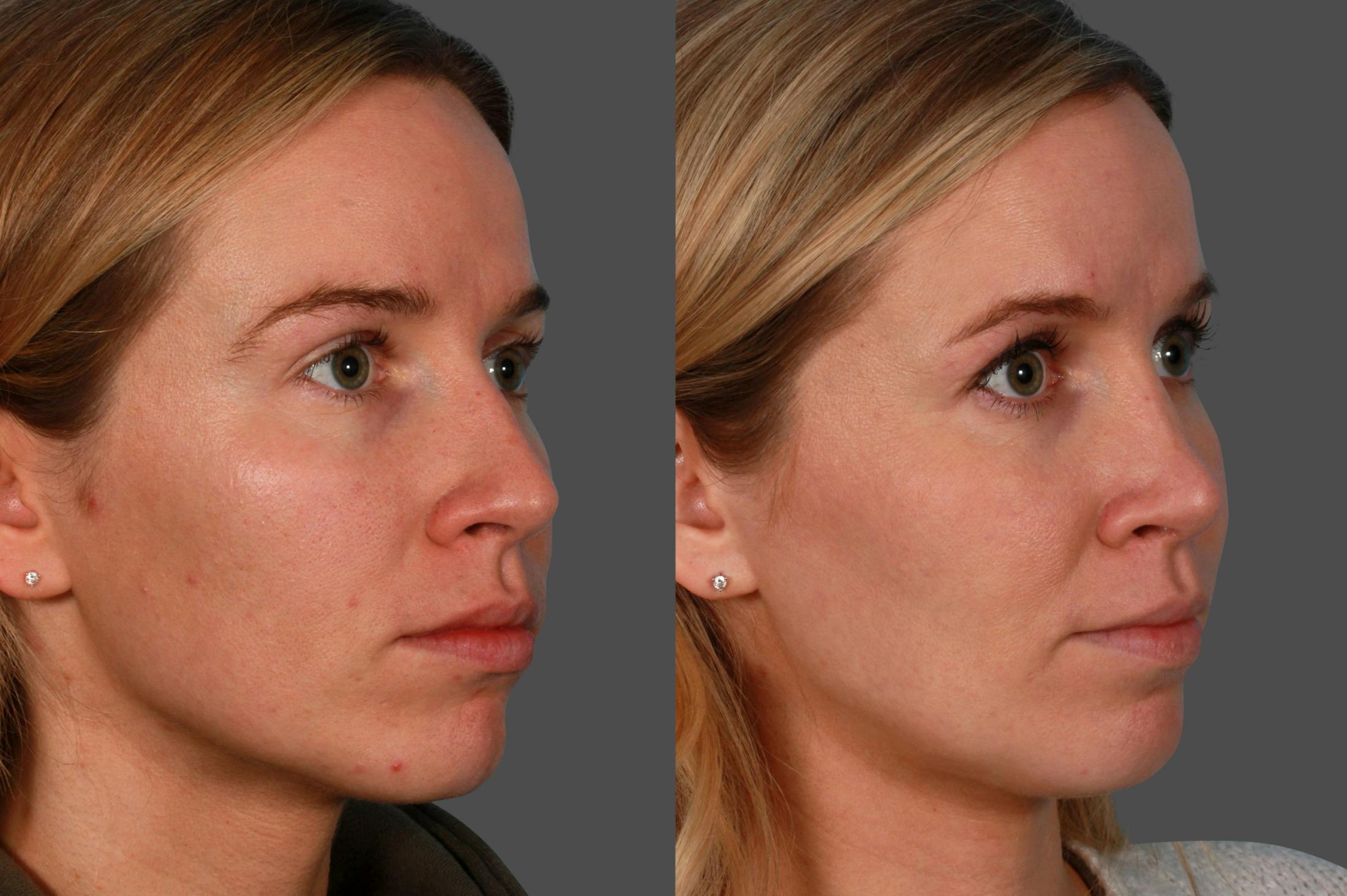Rhinoplasty Before & After Gallery - Patient 937377 - Image 2