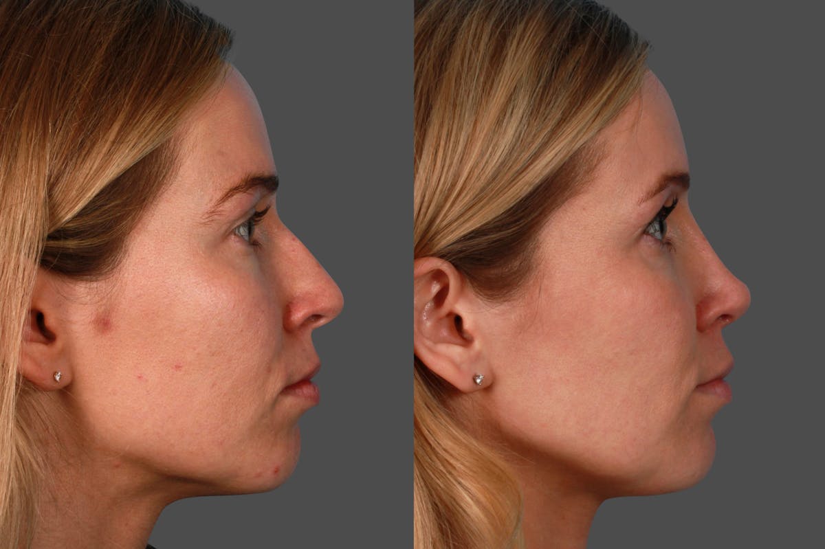 Rhinoplasty Before & After Gallery - Patient 937377 - Image 3