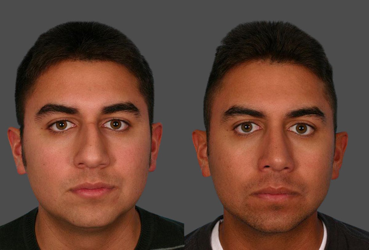 Nasal Obstruction Before & After Gallery - Patient 151758 - Image 1