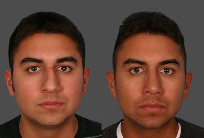 Rhinoplasty Before & After Gallery - Patient 309808 - Image 1
