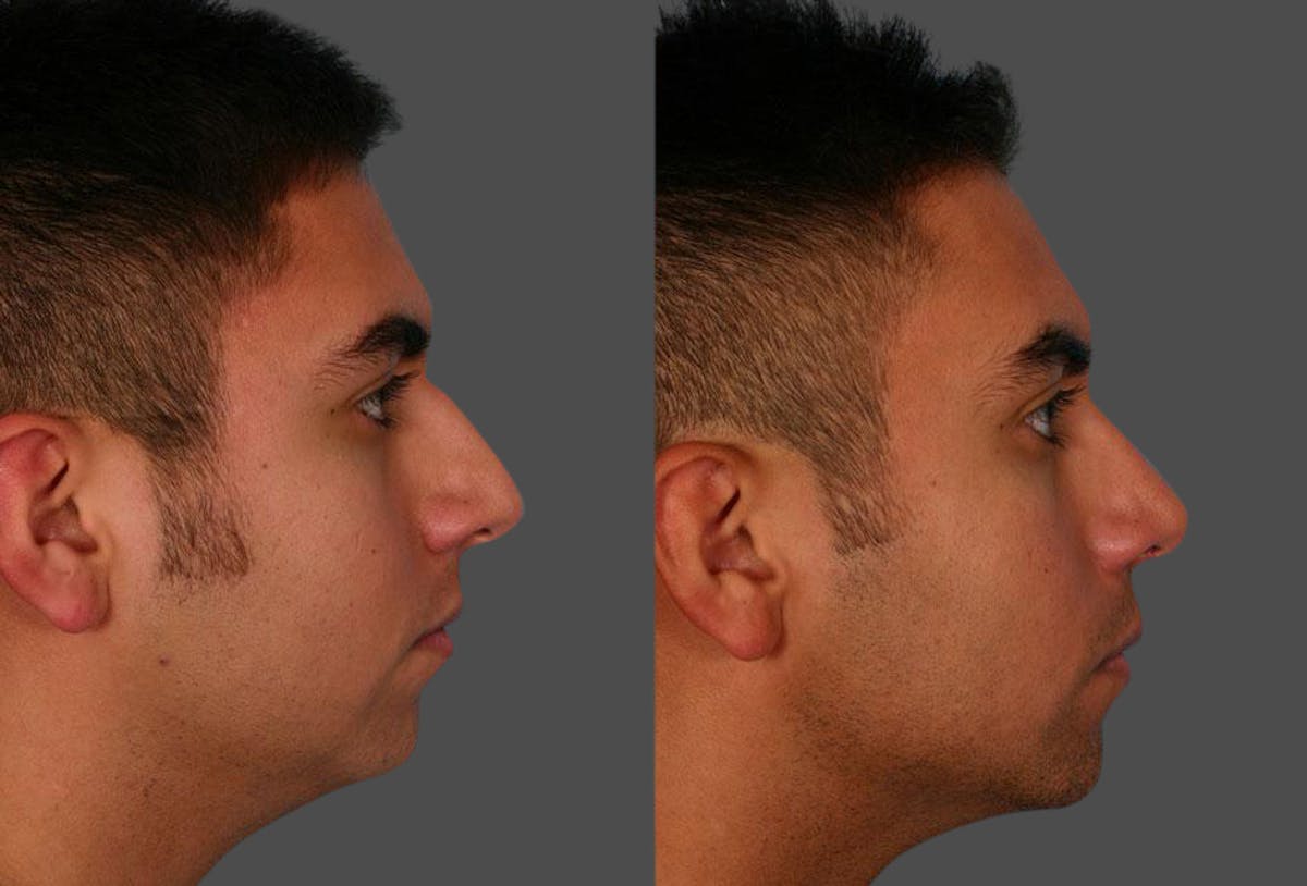 Nasal Obstruction Before & After Gallery - Patient 151758 - Image 2