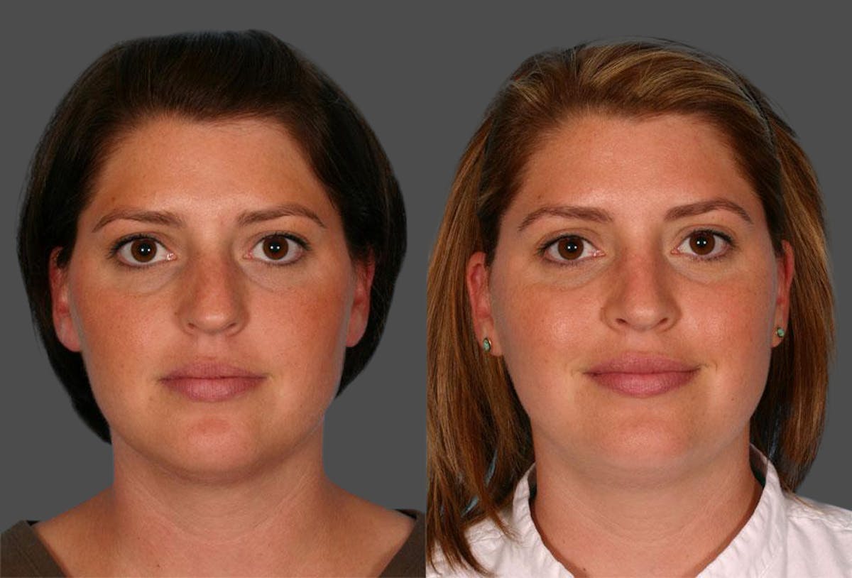 Nasal Obstruction Before & After Gallery - Patient 152009 - Image 1