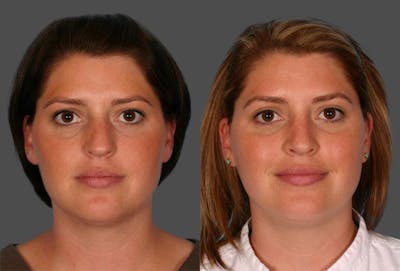 Nasal Obstruction Before & After Gallery - Patient 152009 - Image 1