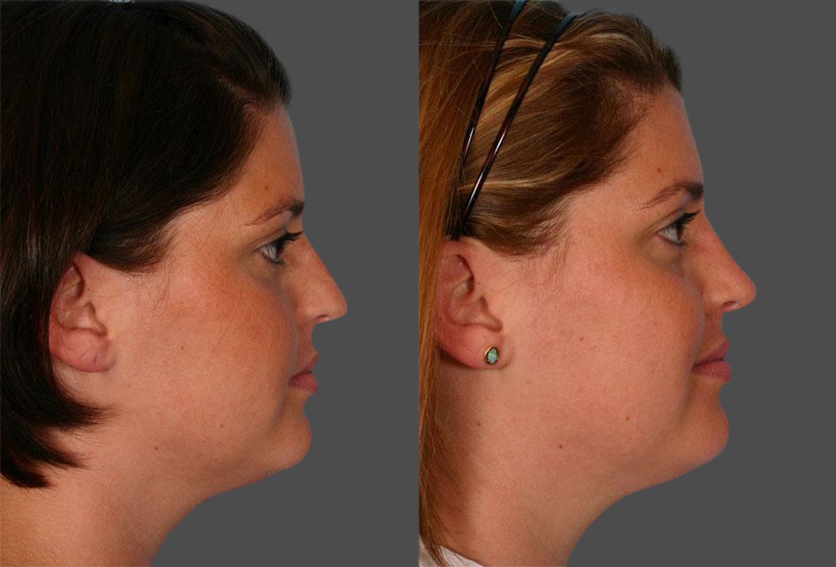 Nasal Obstruction Before & After Gallery - Patient 152009 - Image 2
