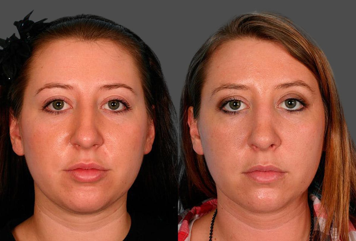 Nasal Obstruction Before & After Gallery - Patient 180789 - Image 1