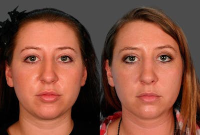 Nasal Obstruction Before & After Gallery - Patient 180789 - Image 1