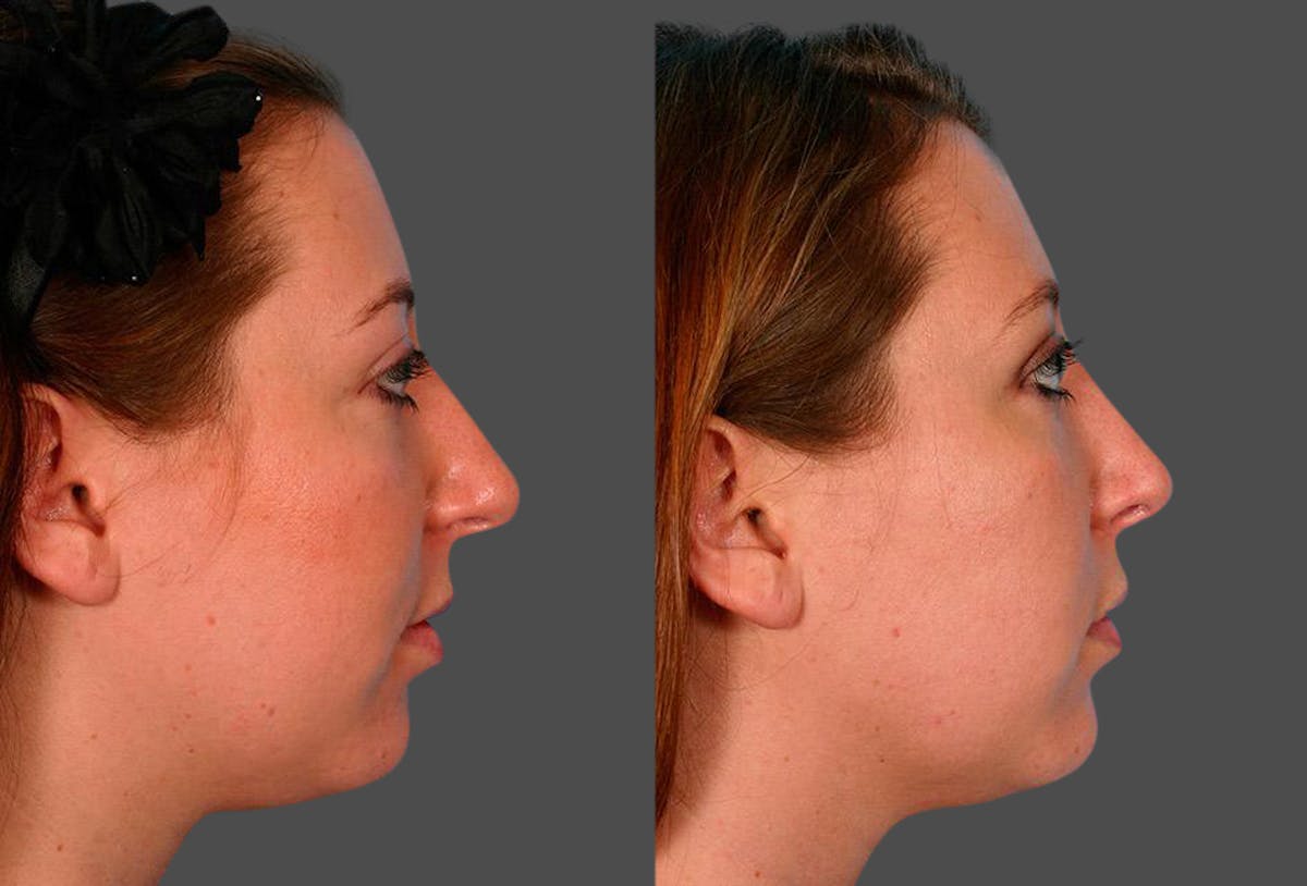 Nasal Obstruction Before & After Gallery - Patient 180789 - Image 2