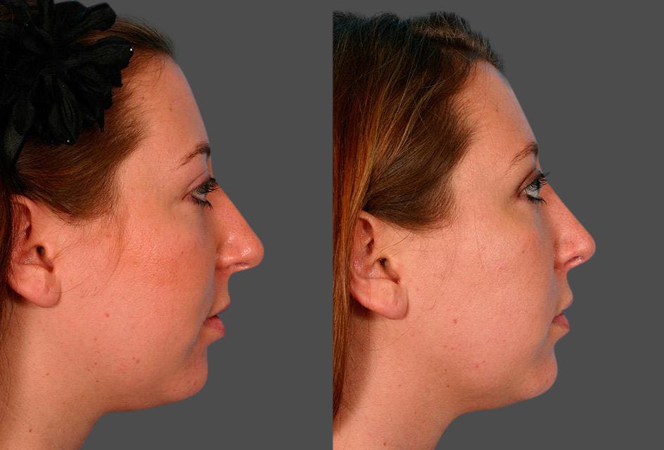 Nasal Obstruction Before & After Gallery - Patient 180789 - Image 2