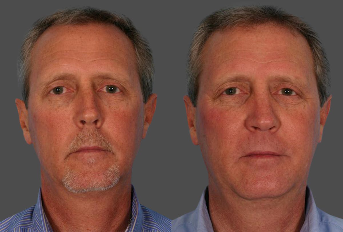 Nasal Obstruction Before & After Gallery - Patient 197788 - Image 1