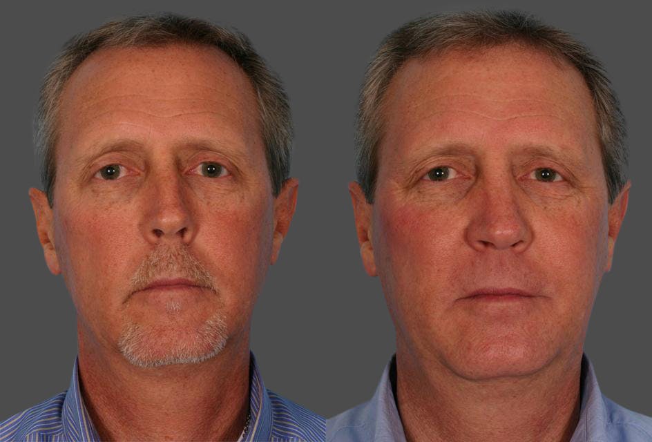 Nasal Obstruction Before & After Gallery - Patient 197788 - Image 1