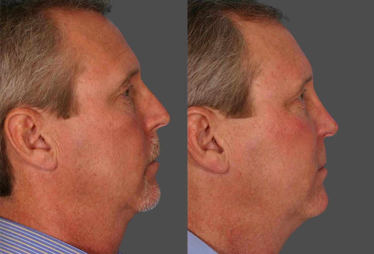 Nasal Obstruction Before & After Gallery - Patient 197788 - Image 2