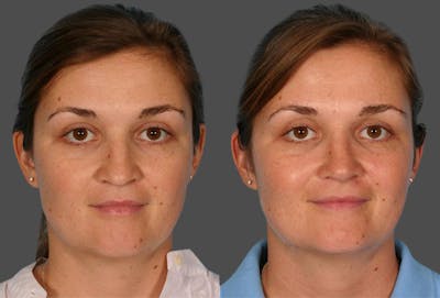 Rhinoplasty Before & After Gallery - Patient 158146 - Image 1