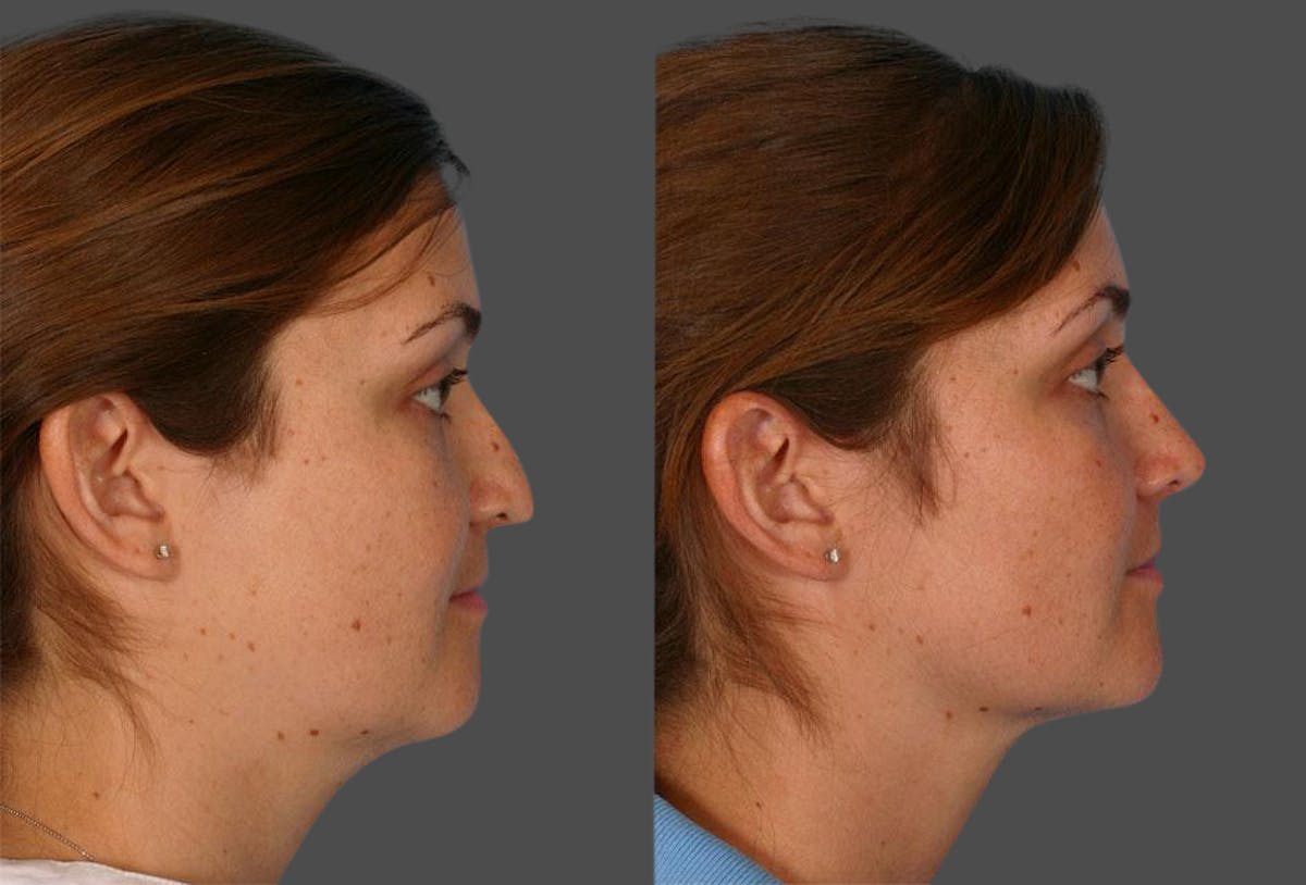Nasal Obstruction Before & After Gallery - Patient 259126 - Image 2