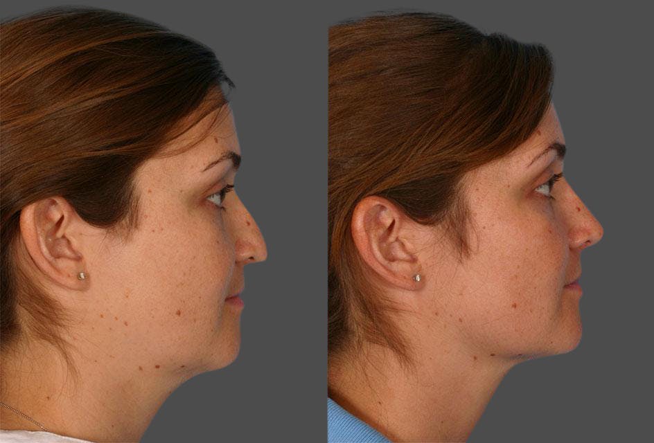 Nasal Obstruction Before & After Gallery - Patient 259126 - Image 2