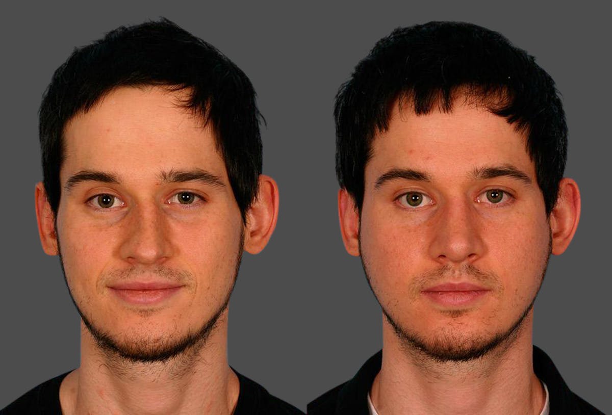 Rhinoplasty Before & After Gallery - Patient 402816 - Image 1