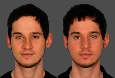 Nasal Obstruction Before & After Gallery - Patient 290720 - Image 1