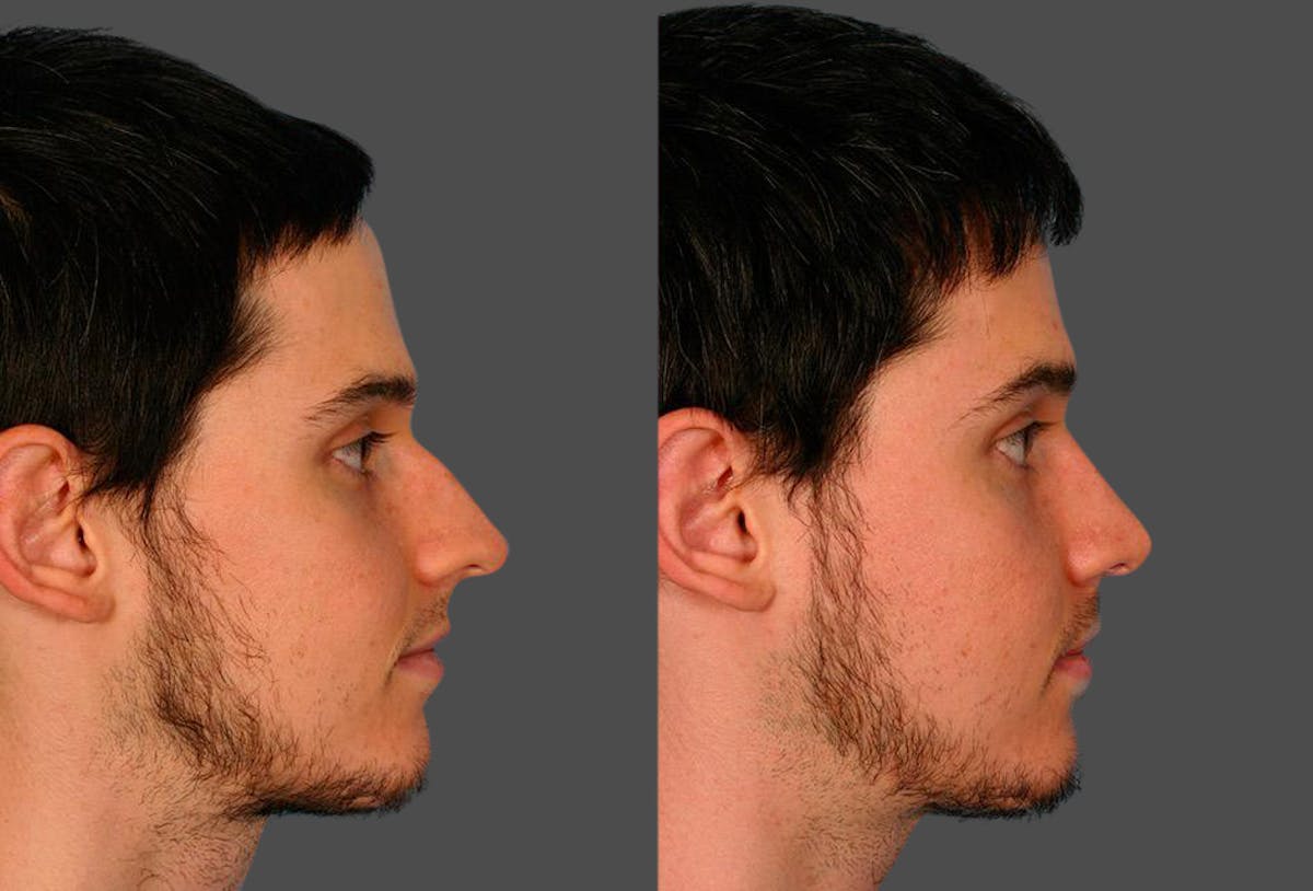 Rhinoplasty Before & After Gallery - Patient 402816 - Image 2