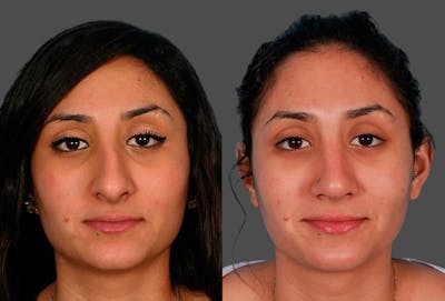 Rhinoplasty Before & After Gallery - Patient 414918 - Image 1