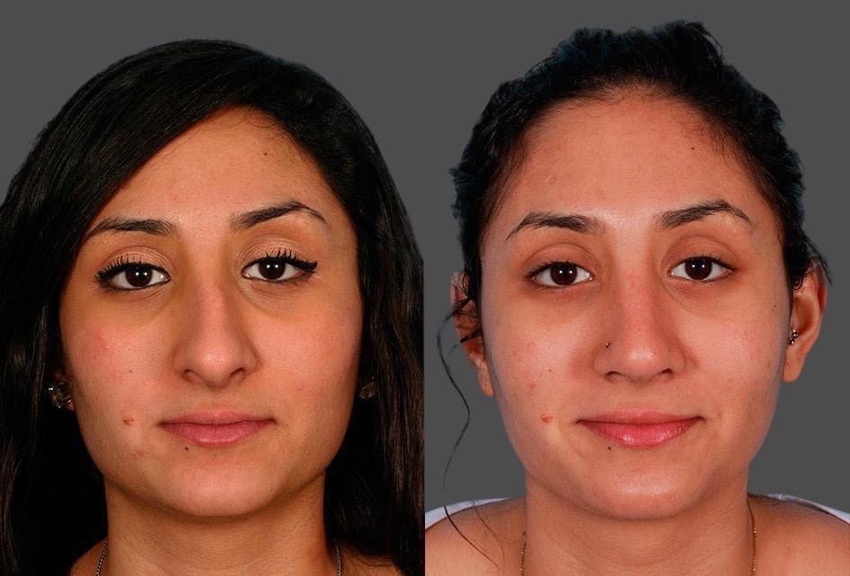 Nasal Obstruction Before & After Gallery - Patient 292079 - Image 1