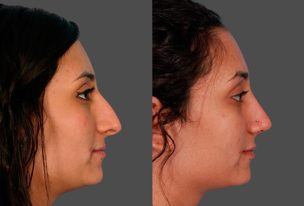 Nasal Obstruction Before & After Gallery - Patient 292079 - Image 2