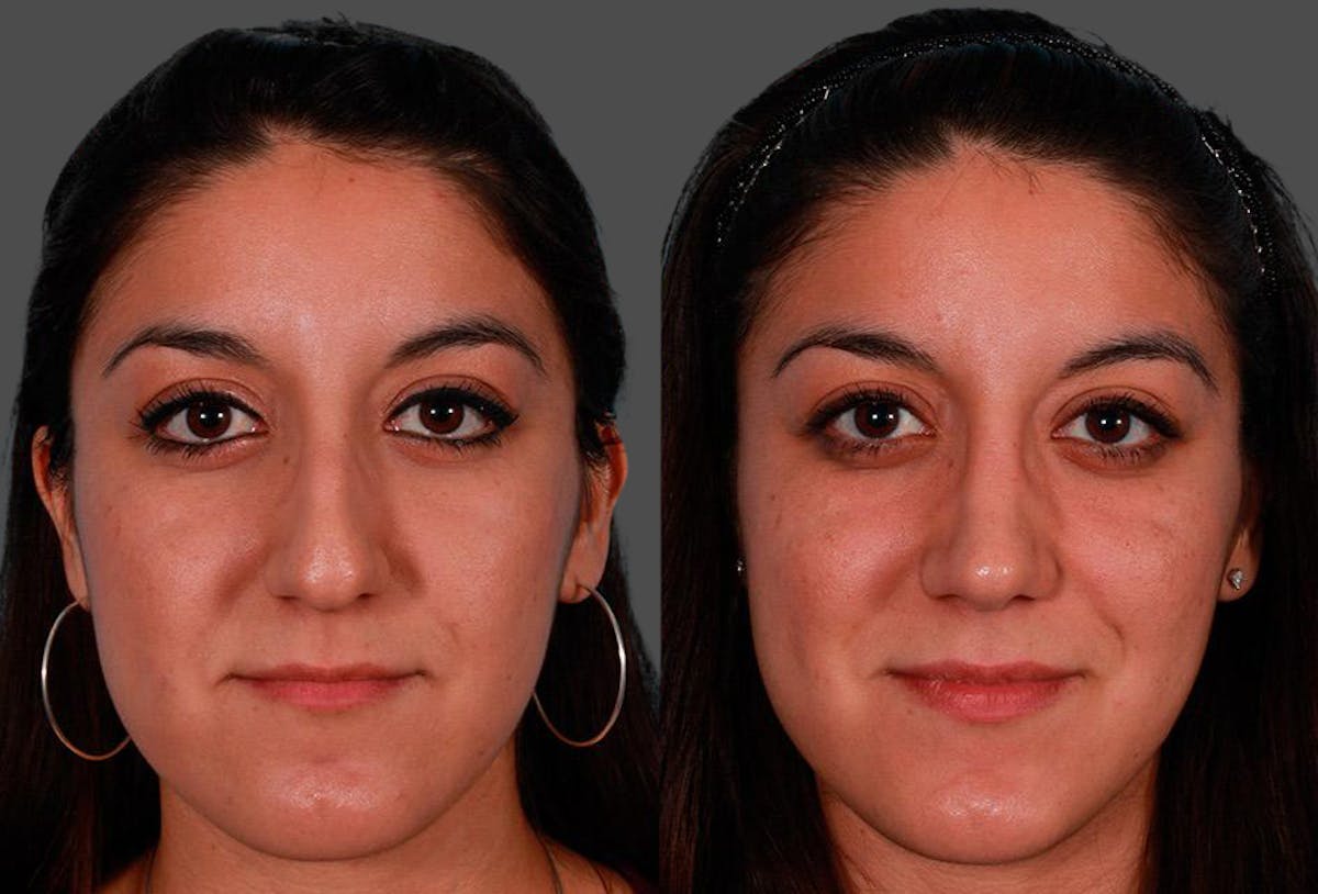 Nasal Obstruction Before & After Gallery - Patient 303066 - Image 1