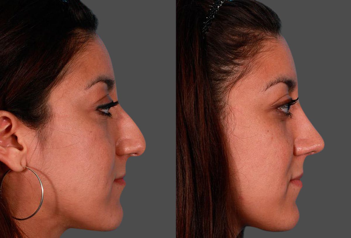 Nasal Obstruction Before & After Gallery - Patient 303066 - Image 2