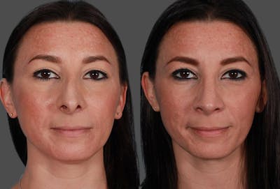 Rhinoplasty Before & After Gallery - Patient 209921 - Image 1