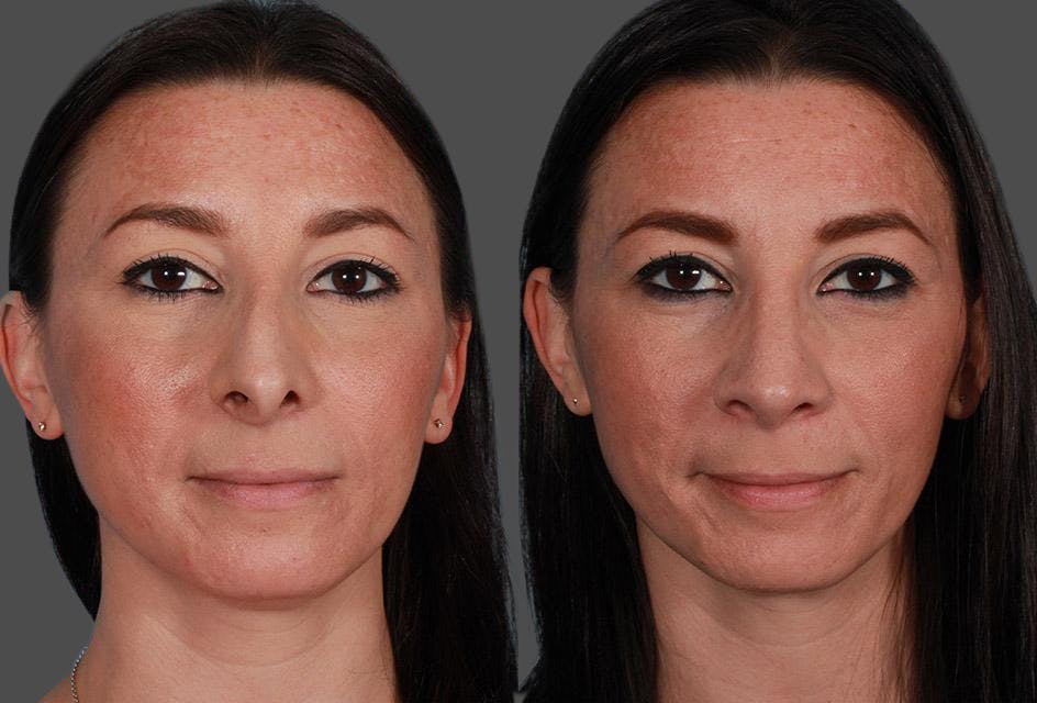 Rhinoplasty Before & After Gallery - Patient 209921 - Image 1