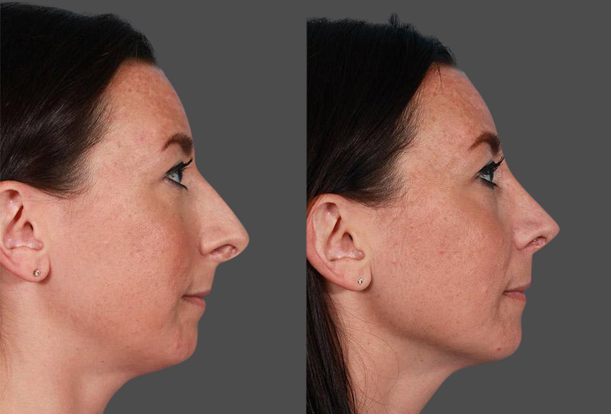 Rhinoplasty Before & After Gallery - Patient 209921 - Image 2