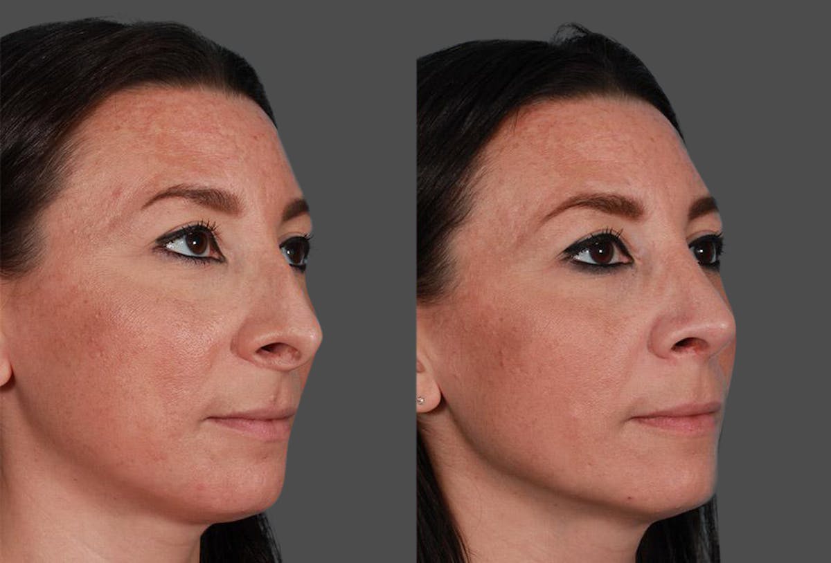 Rhinoplasty Before & After Gallery - Patient 209921 - Image 3