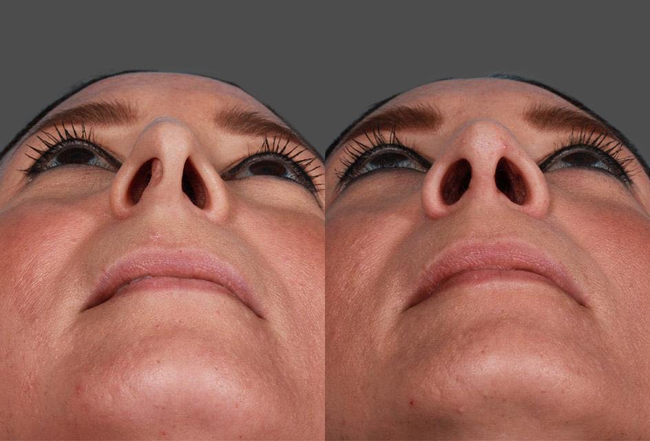 Rhinoplasty Before & After Gallery - Patient 209921 - Image 4