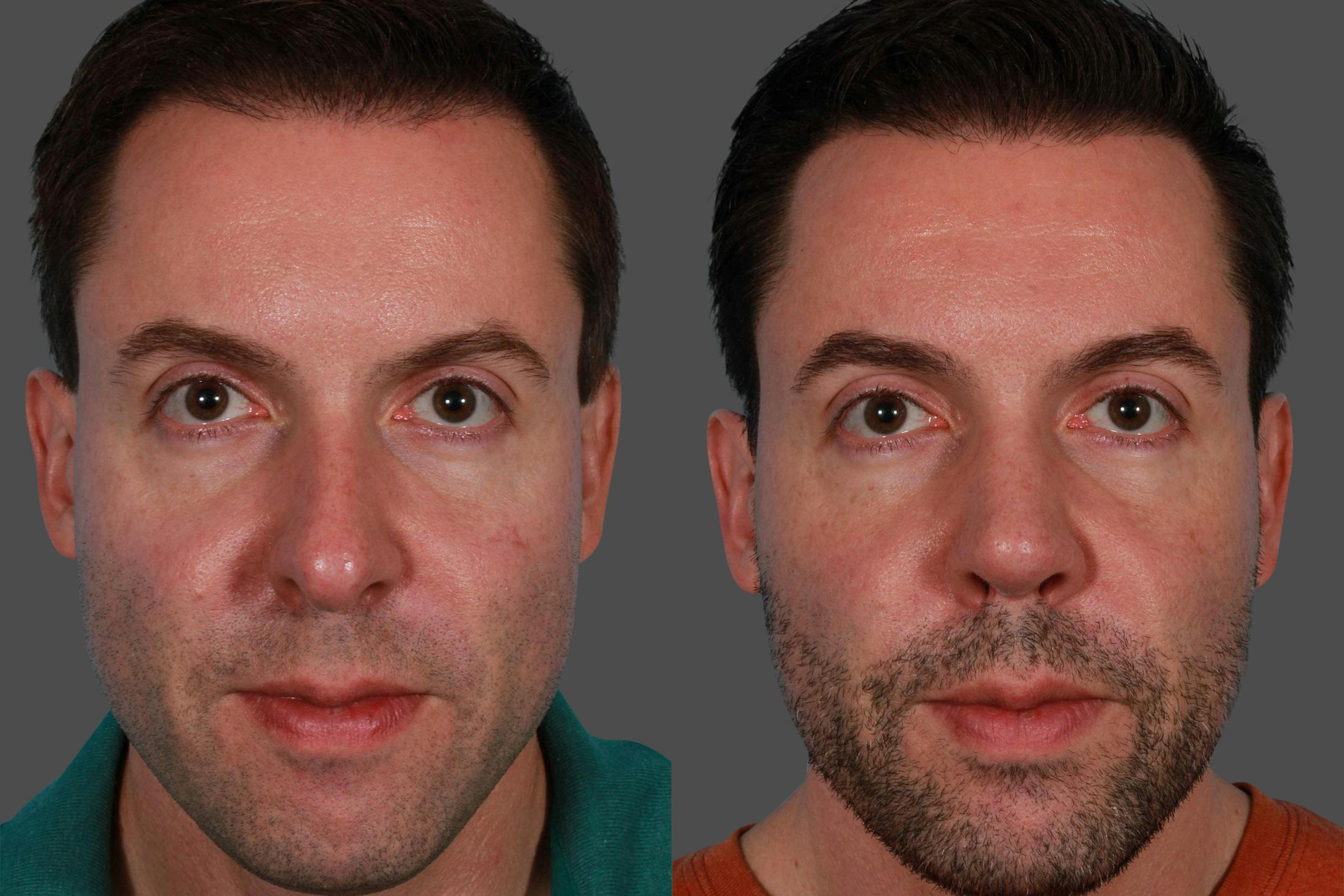Nasal Obstruction Before & After Gallery - Patient 309474 - Image 1