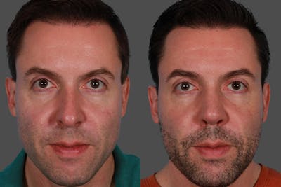 Nasal Obstruction Before & After Gallery - Patient 309474 - Image 1