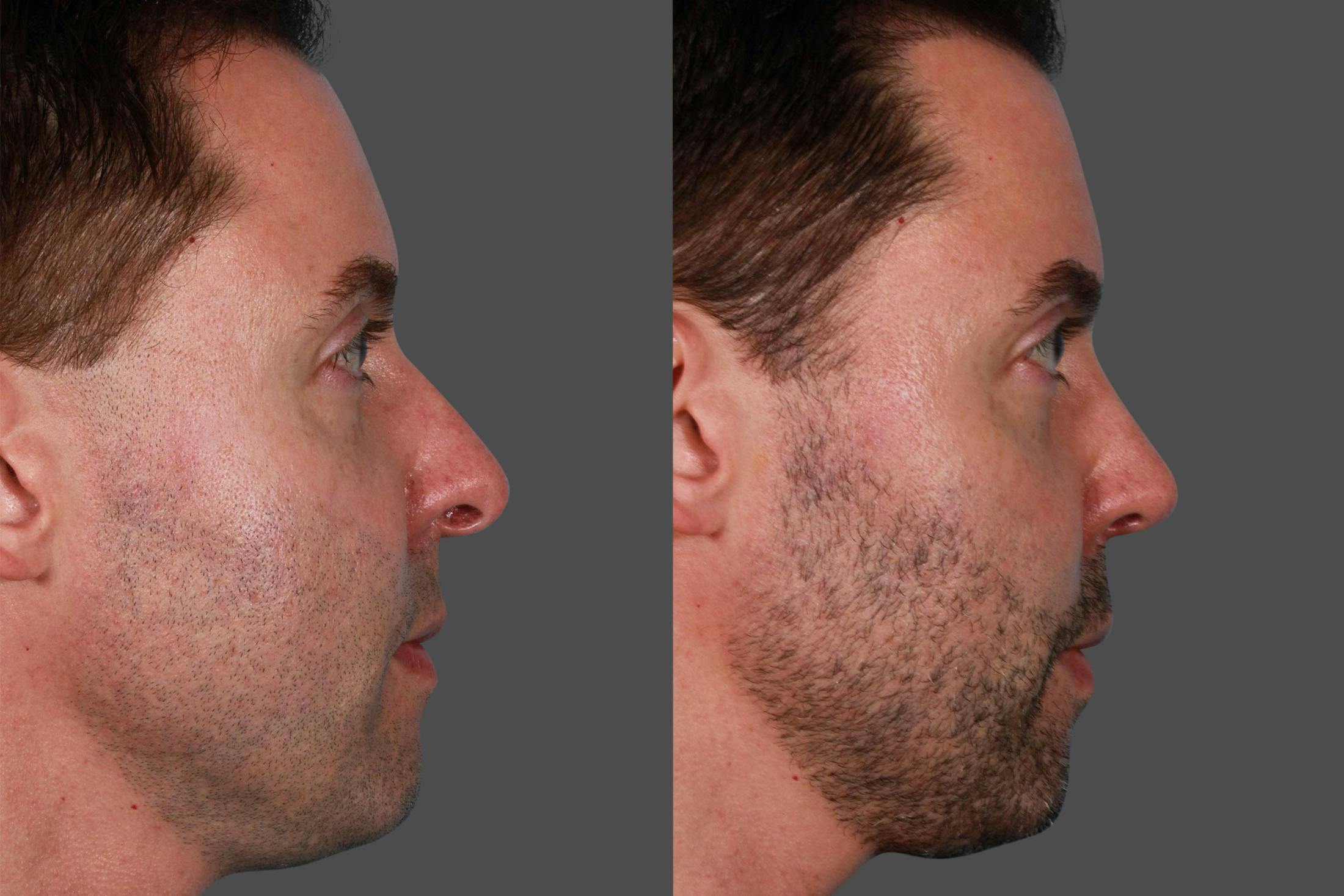 Nasal Obstruction Before & After Gallery - Patient 309474 - Image 2