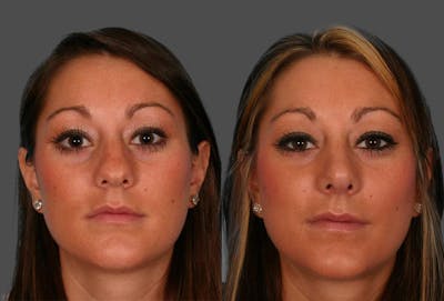Rhinoplasty Before & After Gallery - Patient 385552 - Image 1
