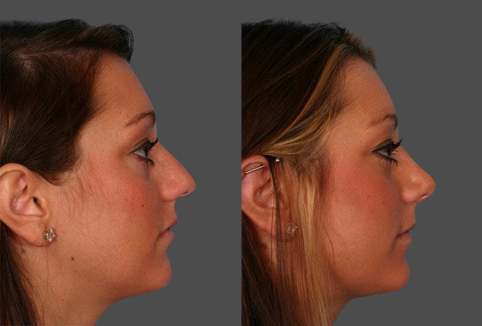 Nasal Obstruction Before & After Gallery - Patient 317462 - Image 2