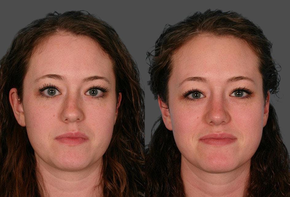 Nasal Obstruction Before & After Gallery - Patient 354688 - Image 1