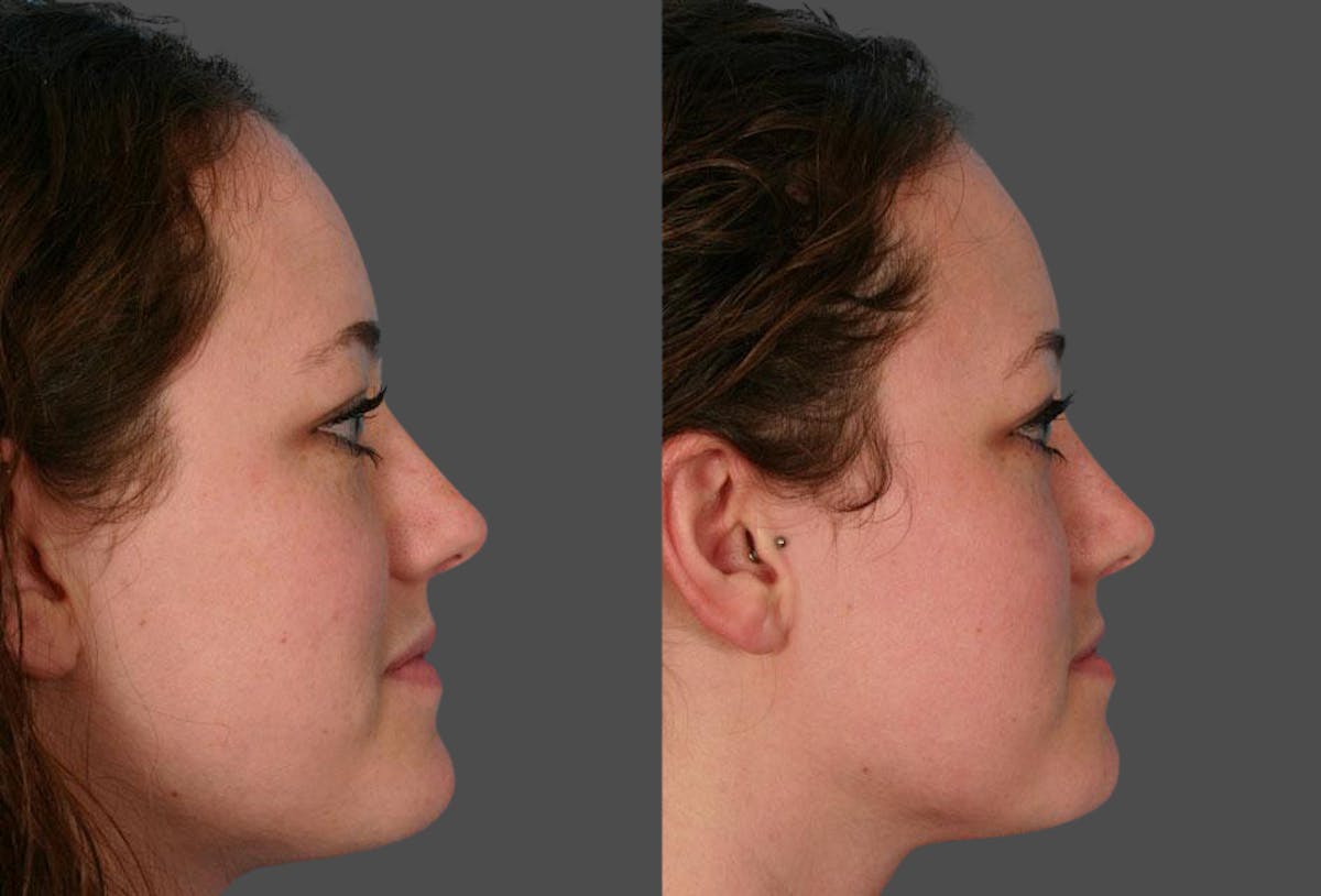 Nasal Obstruction Before & After Gallery - Patient 354688 - Image 2