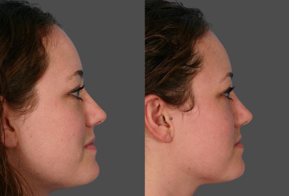 Nasal Obstruction Before & After Gallery - Patient 354688 - Image 2