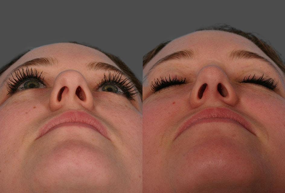 Nasal Obstruction Before & After Gallery - Patient 354688 - Image 3