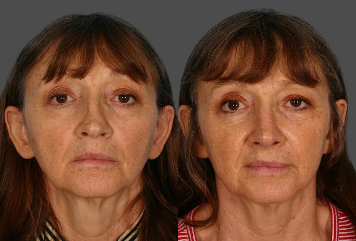 Nasal Obstruction Before & After Gallery - Patient 377226 - Image 1