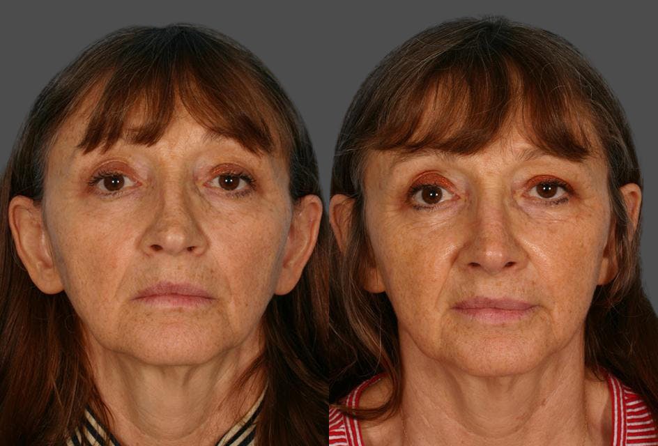 Nasal Obstruction Before & After Gallery - Patient 377226 - Image 1