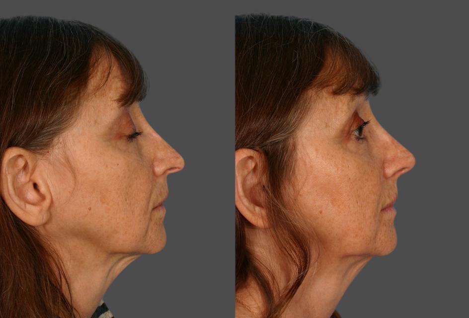 Nasal Obstruction Before & After Gallery - Patient 377226 - Image 2